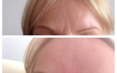 How Long Does Botox Take To Work?