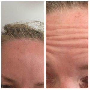 Botox Results 4 - Nunthorpe Aesthetics