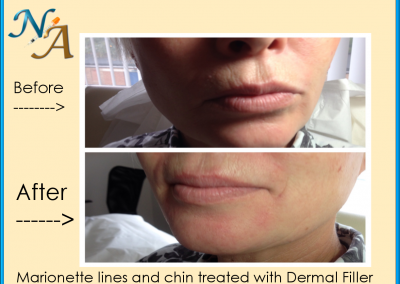 Chin and Jaw Filler