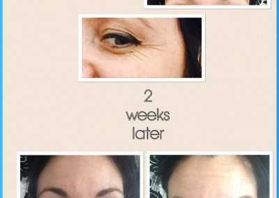 Nunthorpe Aesthetics - Botox to treat crows feet and in between the eyebrows (glabella). Results shown two weeks