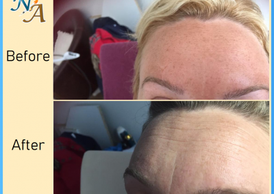 Nunthorpe Aesthetics -Botox treated on two areas of forehead.