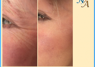 Nunthorpe Aesthetics - Botox treating crows feet