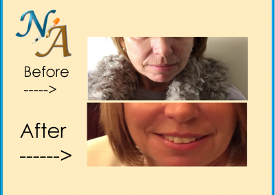 Nunthorpe Aesthetics -Cheek and chin augmentation using Dermal Filler
