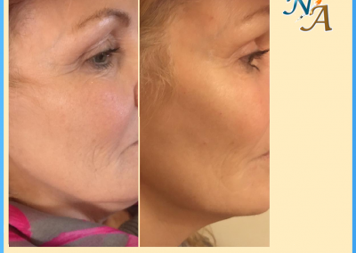 Nunthorpe Aesthetics - Cheek augmentation using Dermal Filler