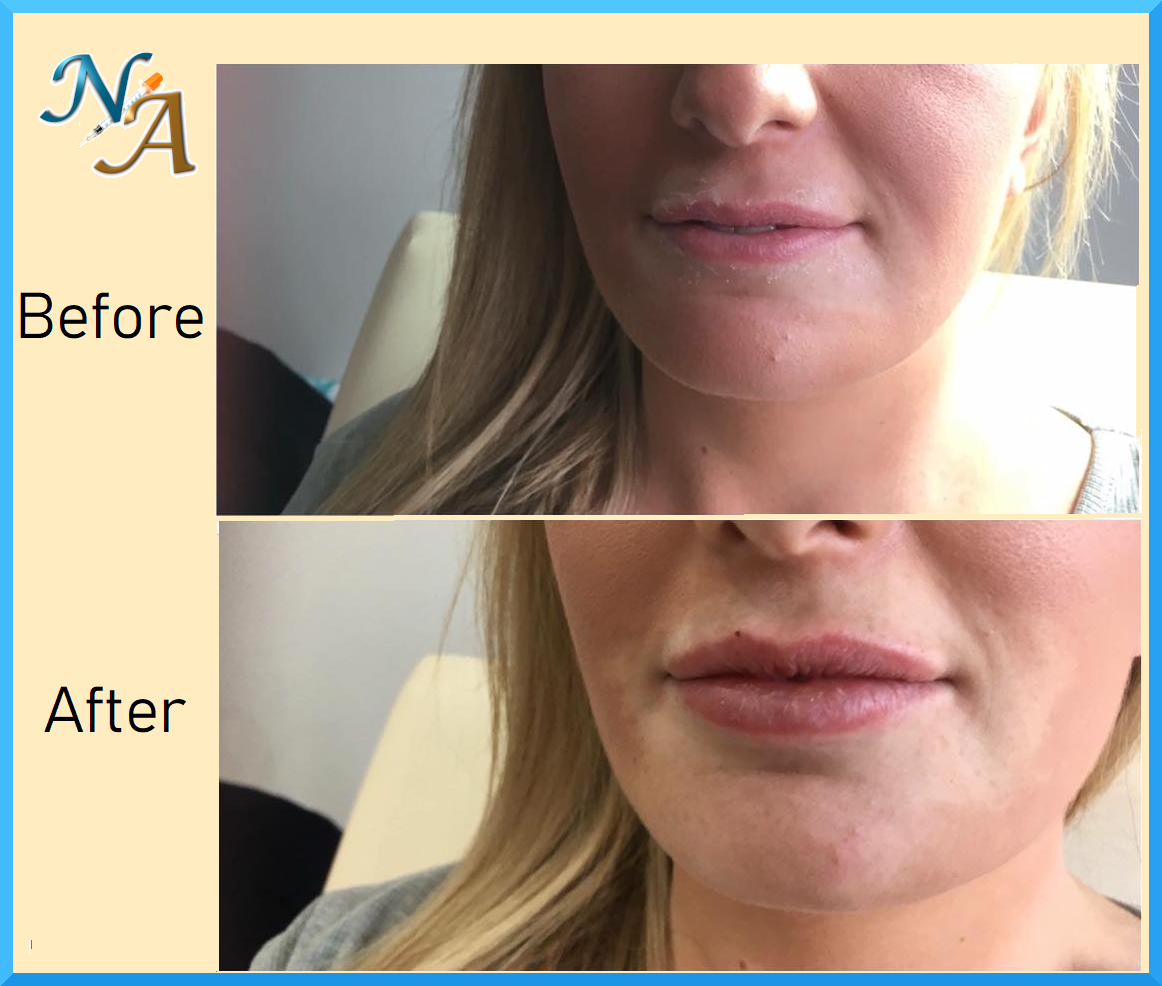 Nunthorpe Aesthetics - Lip augmentation using Dermal Filler Nunthorpe Aesthetics - Lip augmentation using Dermal Filler