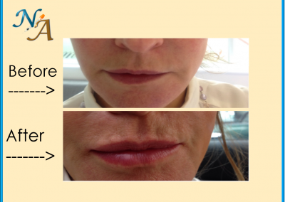Nunthorpe Aesthetics -Lip augmentation using Juvederm Dermal Filler