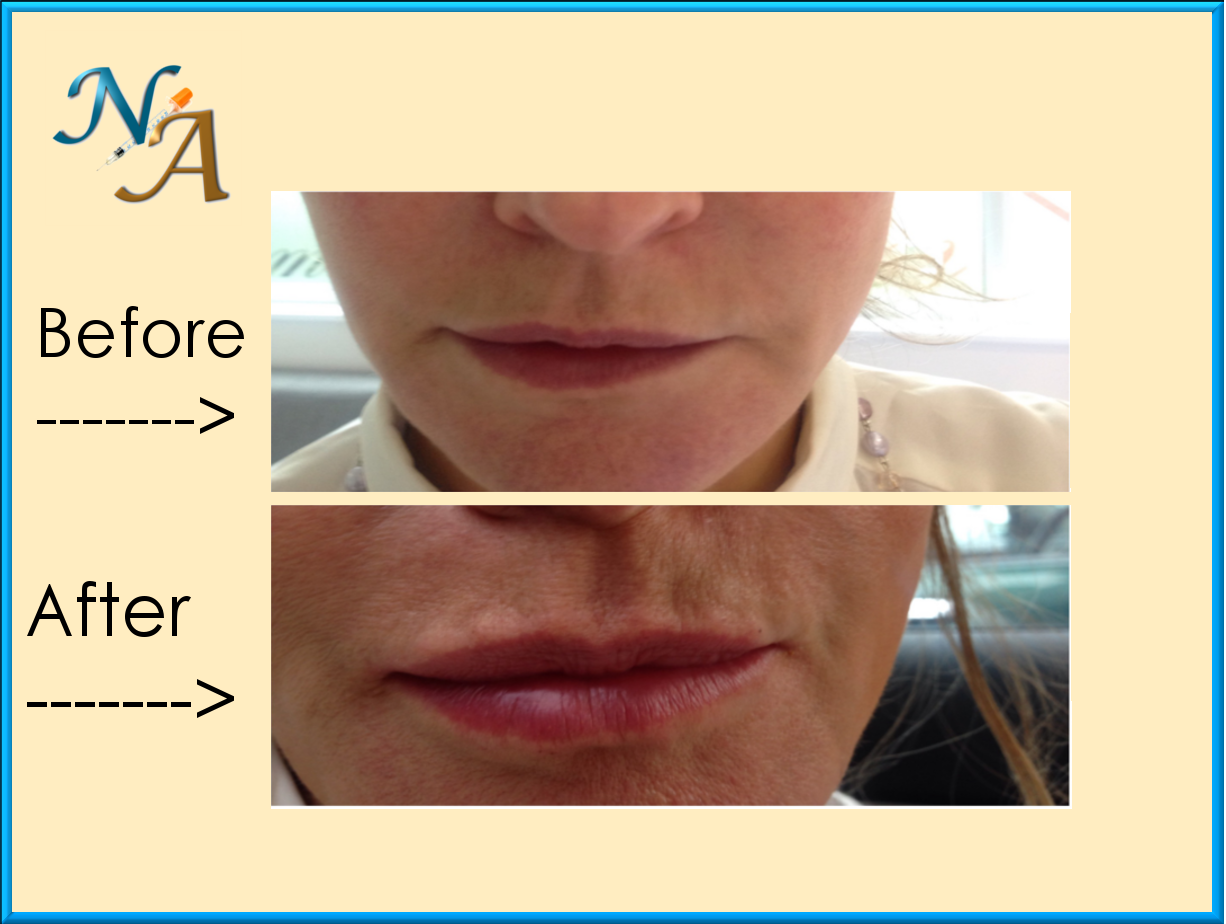 Nunthorpe Aesthetics -Lip augmentation using Juvederm Dermal Filler Nunthorpe Aesthetics -Lip augmentation using Juvederm Dermal Filler