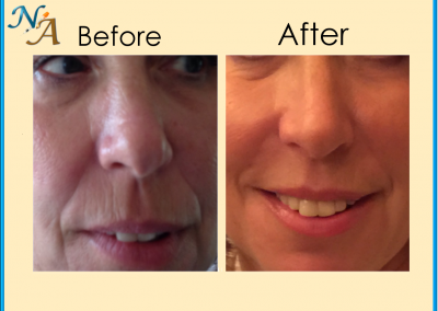 Nunthorpe Aesthetics - Non-surgical 8-point lift using Dermal Fillers, before and after treatment.